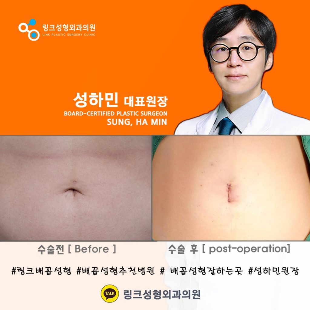 belly button reshaping_bellybuttonsurgery_linkplasticsurgery_link plastic surgery_dr.sung__ศัลยกรรมตกแต่งสะดือ_โรงพยาบาลศัลยกรรมลิงค์_13
