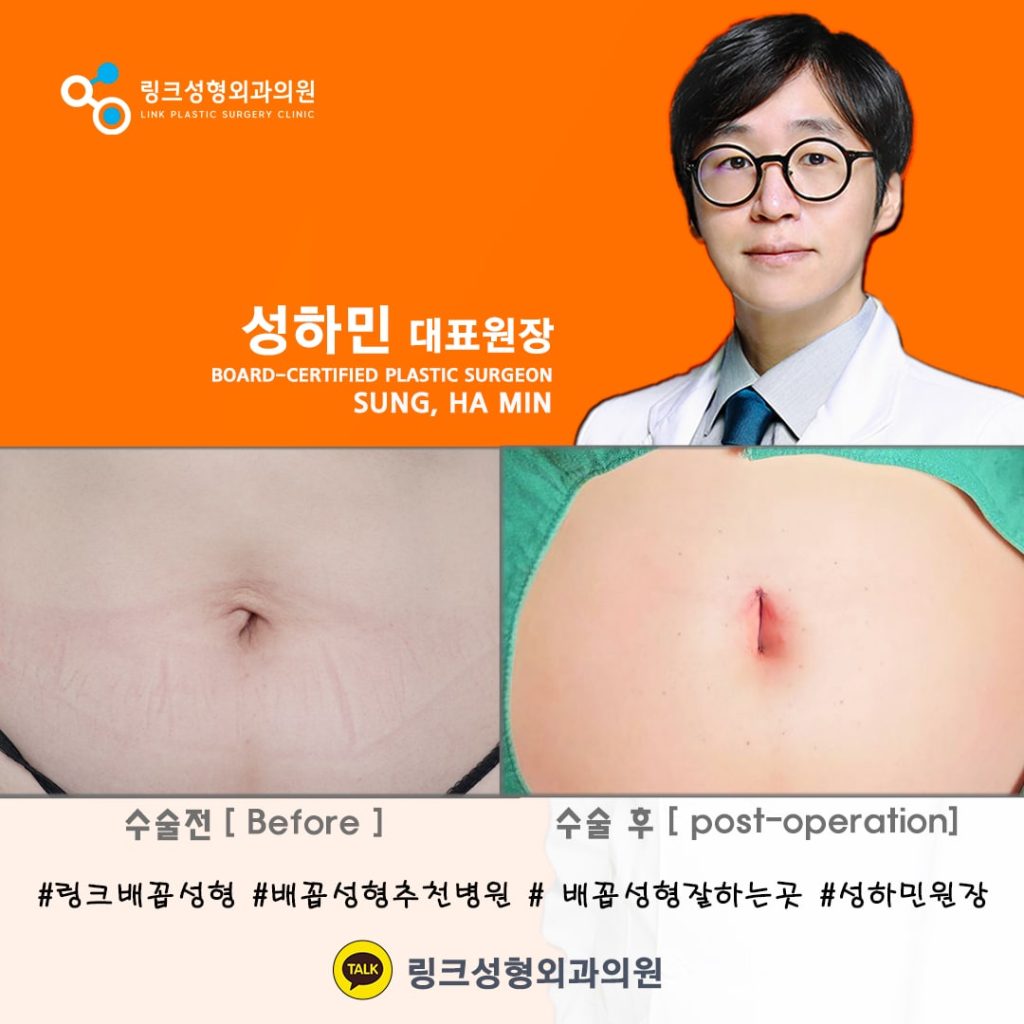 belly button reshaping_bellybuttonsurgery_linkplasticsurgery_link plastic surgery_dr.sung__ศัลยกรรมตกแต่งสะดือ_โรงพยาบาลศัลยกรรมลิงค์_14