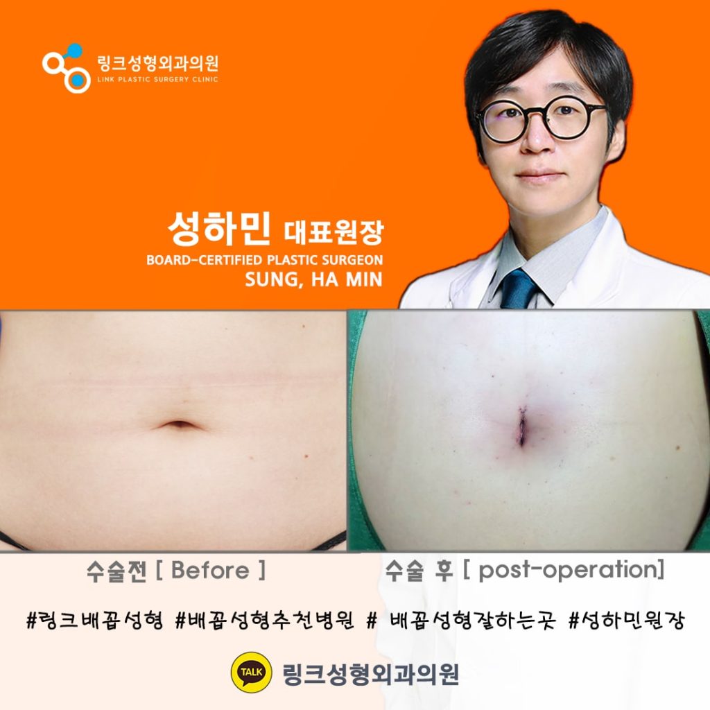 belly button reshaping_bellybuttonsurgery_linkplasticsurgery_link plastic surgery_dr.sung__ศัลยกรรมตกแต่งสะดือ_โรงพยาบาลศัลยกรรมลิงค์_10