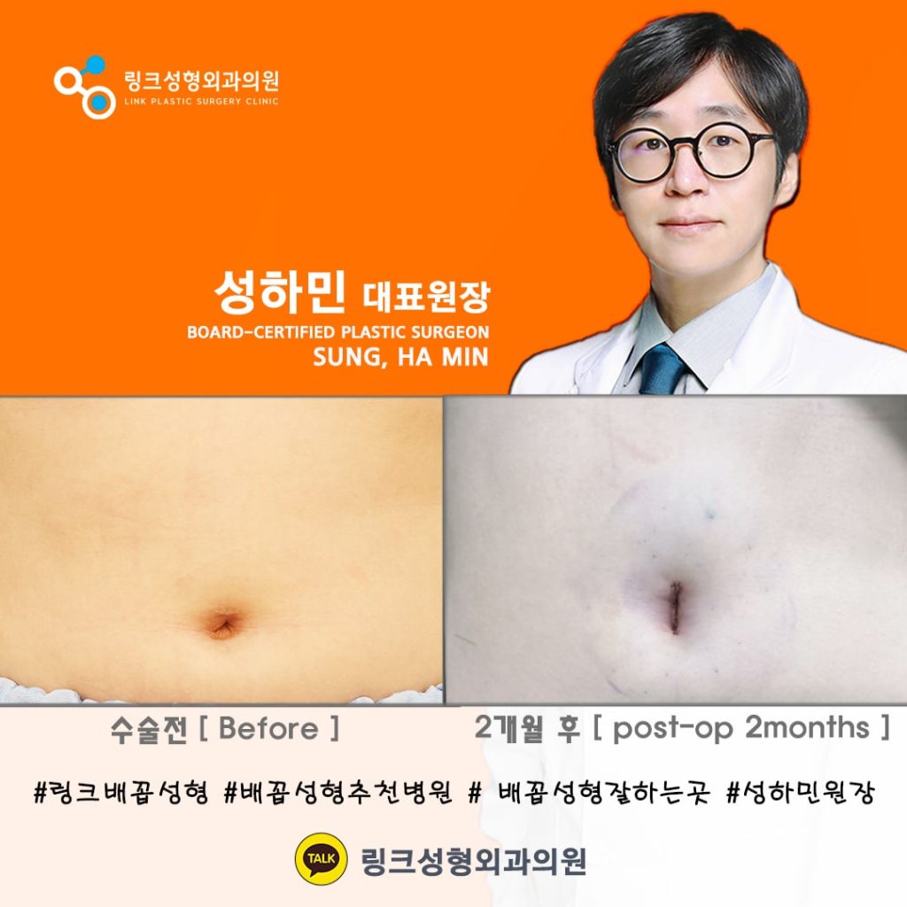 BELLY BUTTON RESHAPING | umbilicoplasty | navel surgery | へそ形成 | 肚脐整形 | 肚臍整形 | ศัลยกรรมตกแต่งสะดือ | ศัลยกรรมสะดือ | PHẪU THUẬT RỐN | ХҮЙСНИЙ НҮХНИЙ ГОО САЙХНЫ МЭС ЗАСАЛ | хэвлийн товчлуурын мэс засал | умбиликопластика | операция на пупке_21