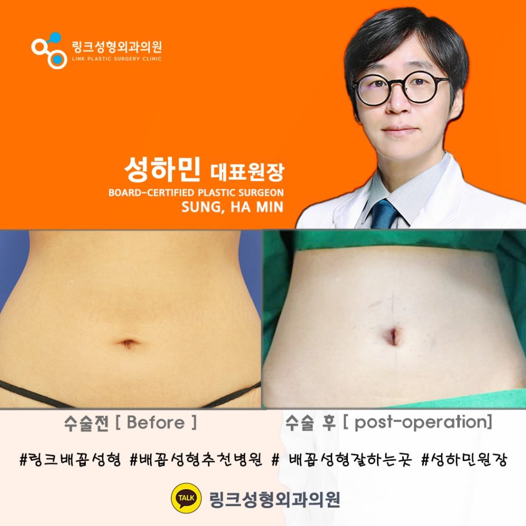 BELLY BUTTON RESHAPING | umbilicoplasty | navel surgery | へそ形成 | 肚脐整形 | 肚臍整形 | ศัลยกรรมตกแต่งสะดือ | ศัลยกรรมสะดือ | PHẪU THUẬT RỐN | ХҮЙСНИЙ НҮХНИЙ ГОО САЙХНЫ МЭС ЗАСАЛ | хэвлийн товчлуурын мэс засал | умбиликопластика | операция на пупке_22