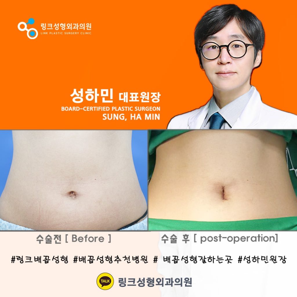 BELLY BUTTON RESHAPING | umbilicoplasty | navel surgery | へそ形成 | 肚脐整形 | 肚臍整形 | ศัลยกรรมตกแต่งสะดือ | ศัลยกรรมสะดือ | PHẪU THUẬT RỐN | ХҮЙСНИЙ НҮХНИЙ ГОО САЙХНЫ МЭС ЗАСАЛ | хэвлийн товчлуурын мэс засал | умбиликопластика | операция на пупке_23