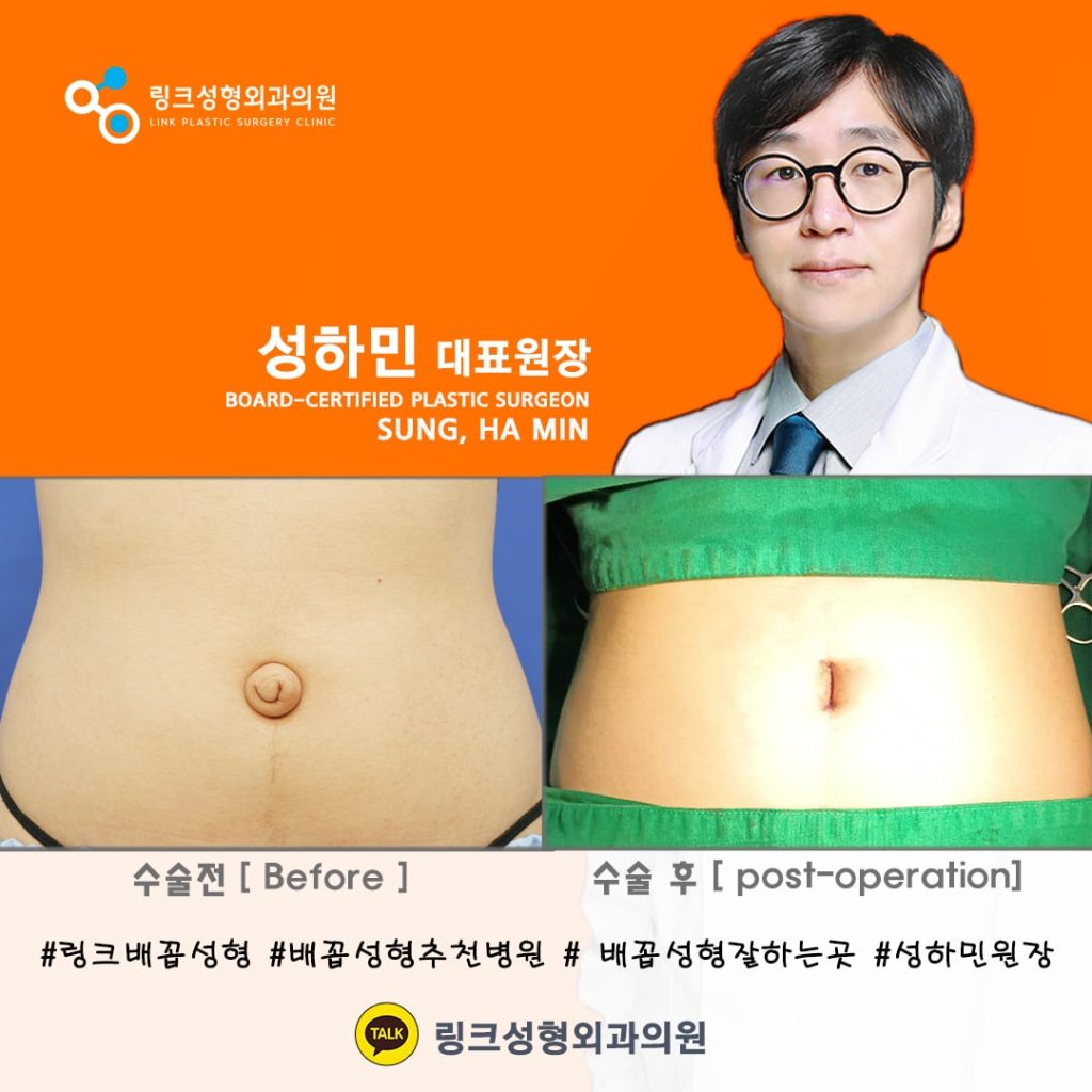 BELLY BUTTON RESHAPING | umbilicoplasty | navel surgery | へそ形成 | 肚脐整形 | 肚臍整形 | ศัลยกรรมตกแต่งสะดือ | ศัลยกรรมสะดือ | PHẪU THUẬT RỐN | ХҮЙСНИЙ НҮХНИЙ ГОО САЙХНЫ МЭС ЗАСАЛ | хэвлийн товчлуурын мэс засал | умбиликопластика | операция на пупке_24