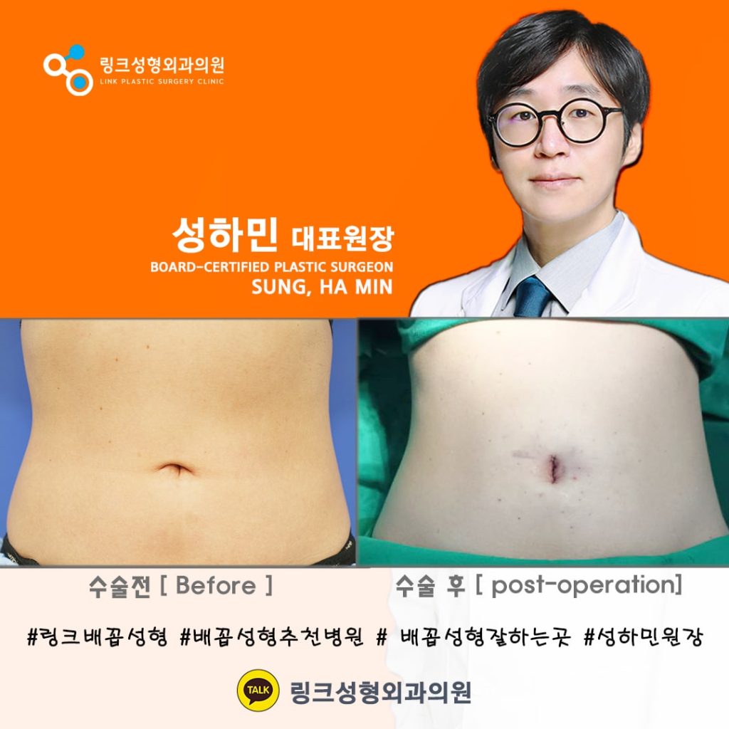 BELLY BUTTON RESHAPING | umbilicoplasty | navel surgery | へそ形成 | 肚脐整形 | 肚臍整形 | ศัลยกรรมตกแต่งสะดือ | ศัลยกรรมสะดือ | PHẪU THUẬT RỐN | ХҮЙСНИЙ НҮХНИЙ ГОО САЙХНЫ МЭС ЗАСАЛ | хэвлийн товчлуурын мэс засал | умбиликопластика | операция на пупке_25