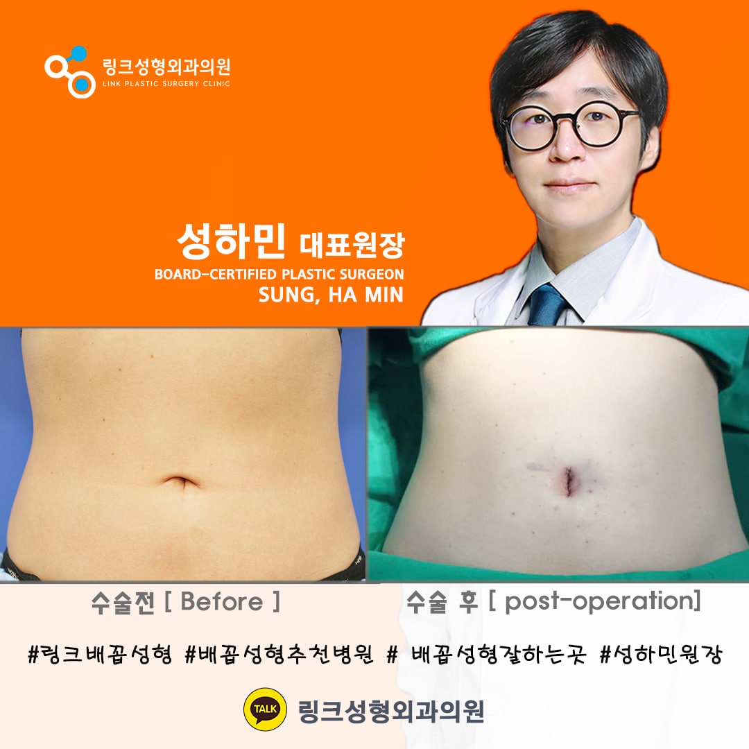 BELLY BUTTON RESHAPING | umbilicoplasty | navel surgery | へそ形成 | 肚脐整形 | 肚臍整形 | ศัลยกรรมตกแต่งสะดือ | ศัลยกรรมสะดือ | PHẪU THUẬT RỐN | ХҮЙСНИЙ НҮХНИЙ ГОО САЙХНЫ МЭС ЗАСАЛ |  хэвлийн товчлуурын мэс засал | умбиликопластика | операция на пупке_25